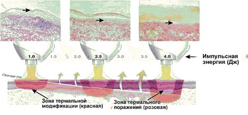  аппарат PLASMAJET ® 